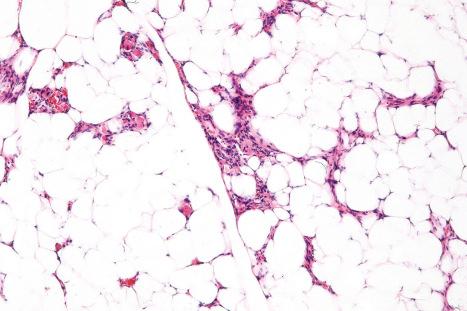 Fig. 35.19, Angiolipoma: admixed with the adipocytes are aggregates of small vessels.