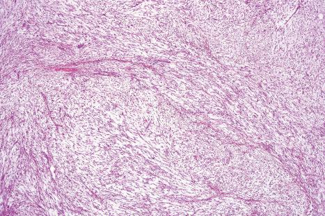 Fig. 35.193, Myxofibrosarcoma: low-grade lesions are relatively hypocellular and contain distinctive curvilinear vessels.