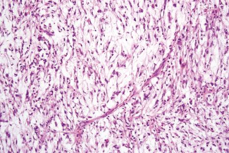 Fig. 35.194, Myxofibrosarcoma: the curvilinear vessels are characteristic.