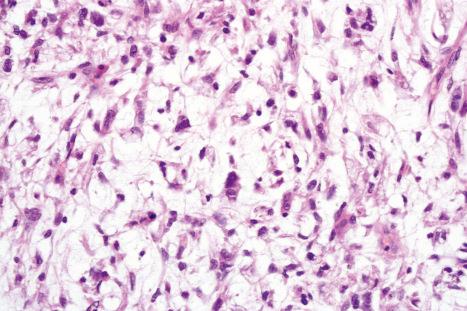 Fig. 35.195, Myxofibrosarcoma: note the pleomorphic tumor cells scattered in the myxoid matrix.