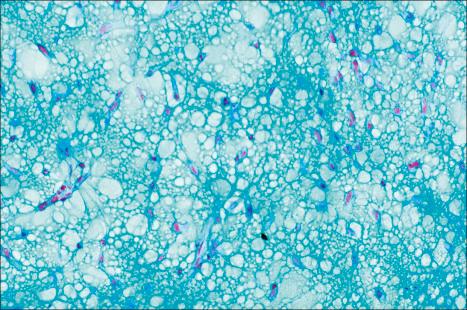 Fig. 35.196, Myxofibrosarcoma: the tumor stains strongly with Alcian blue at pH 2.5, indicating the presence of hyaluronic acid.