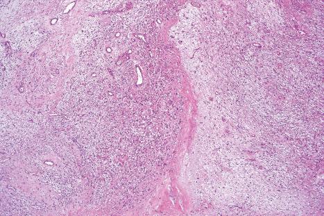 Fig. 35.197, Myxofibrosarcoma: in this field, the multinodularity is emphasized.