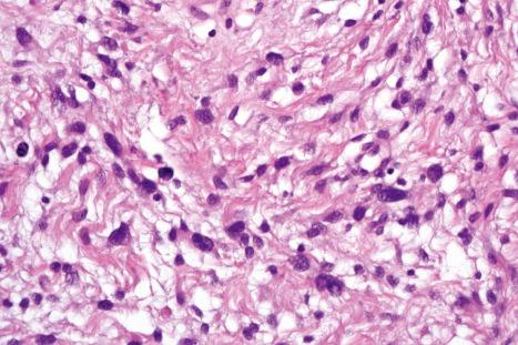 Fig. 35.198, Myxofibrosarcoma: there is marked nuclear pleomorphism.