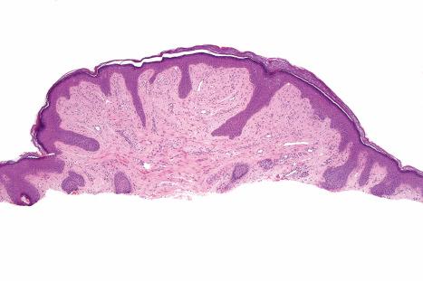 Fig. 35.199, Fibrous papule: shave biopsy from a lesion on the bridge of the nose. The dermis shows dense collagenous tissue.