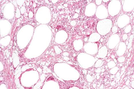 Fig. 35.2, Lipoma: post-traumatic fat necrosis.