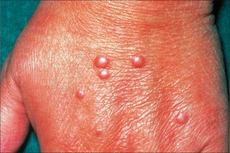 Fig. 35.201, Multinucleate cell angiohistiocytoma: multiple papules are present.