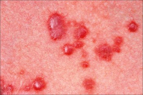 Fig. 35.203, Multinucleate cell angiohistiocytoma: in this example, the papules appear hemorrhagic.