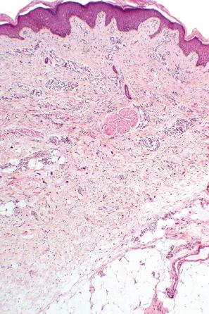 Fig. 35.204, Multinucleate cell angiohistiocytoma: within the dermis is a vascular and collagenous proliferative lesion with conspicuous multinucleate giant cells.