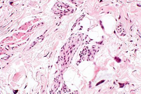 Fig. 35.205, Multinucleate cell angiohistiocytoma: medium-power view showing vessels with giant cells and pericytes.