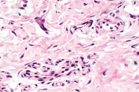 Fig. 35.206, Multinucleate cell angiohistiocytoma: high-power view of giant cell.