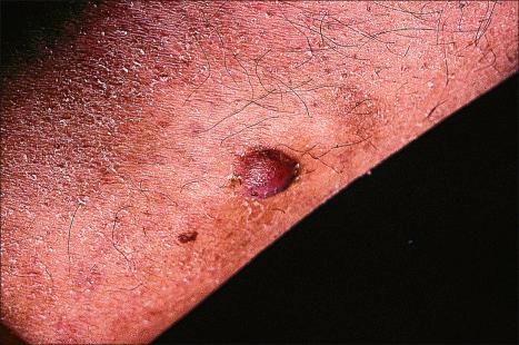 Fig. 35.208, Fibrous histiocytoma (dermatofibroma): dark brown (due to hemosiderin deposition) lesions are sometimes mistaken for melanocytic tumors, including melanoma.