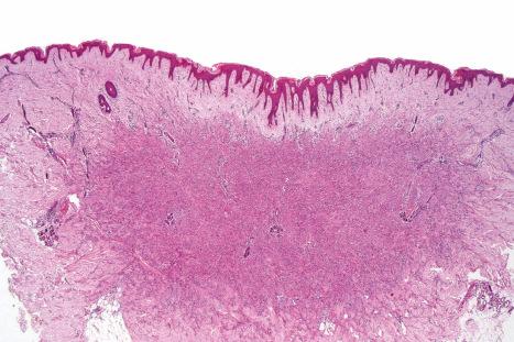 Fig. 35.209, Fibrous histiocytoma (dermatofibroma): scanning section showing the characteristic architecture. The lateral borders of the lesion interdigitate with the adjacent dermis. There is hyperkeratosis and acanthosis of the overlying epidermis.