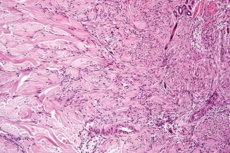 Fig. 35.210, Fibrous histiocytoma (dermatofibroma): the tumor extends into the adjacent normal dermis.