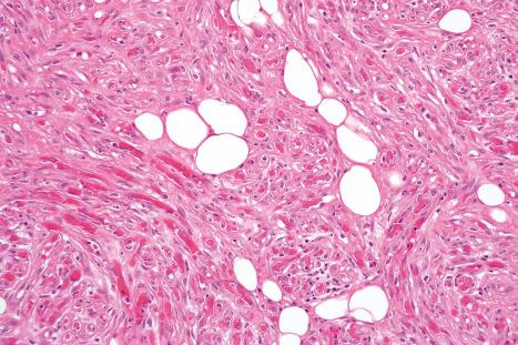 Fig. 35.21, Cellular angiolipoma: in this variant, bland spindled cells (possibly pericytes) predominate. The presence of adipocytes and capillary microthrombi confirms the diagnosis.