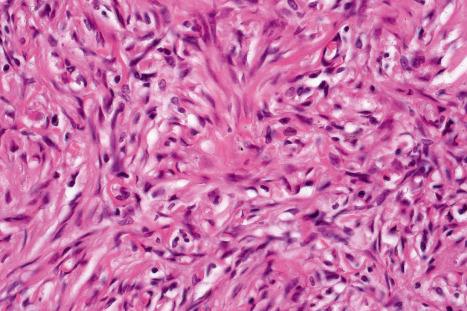 Fig. 35.211, Fibrous histiocytoma (dermatofibroma): high-power view showing storiform growth pattern.