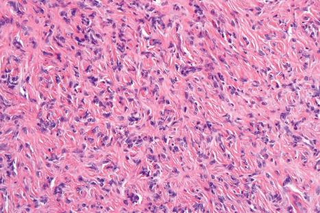 Fig. 35.212, Fibrous histiocytoma (dermatofibroma): the tumor is composed of uniform, interlacing spindle cells in a vaguely curlicue pattern embedded in a hyaline collagenous stroma.