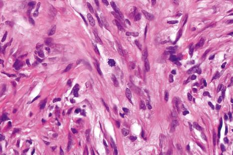 Fig. 35.213, Fibrous histiocytoma (dermatofibroma): occasional normal mitotic figures may be seen.