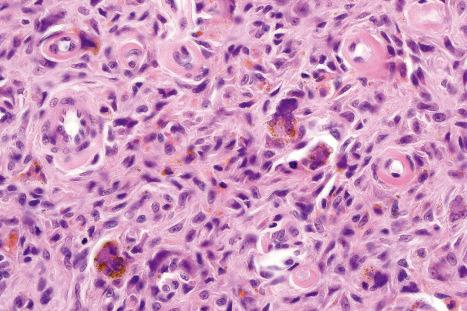 Fig. 35.214, Fibrous histiocytoma (dermatofibroma): scattered multinucleated giant cells are a not infrequent feature of this lesion. Note the hemosiderin pigment.