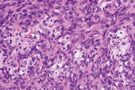 Fig. 35.216, Fibrous histiocytoma (dermatofibroma): high-power view.