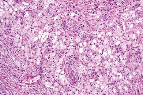 Fig. 35.217, Fibrous histiocytoma (dermatofibroma): when the lipid-laden histiocytes are numerous, this lesion is sometimes called histiocytoma cutis.