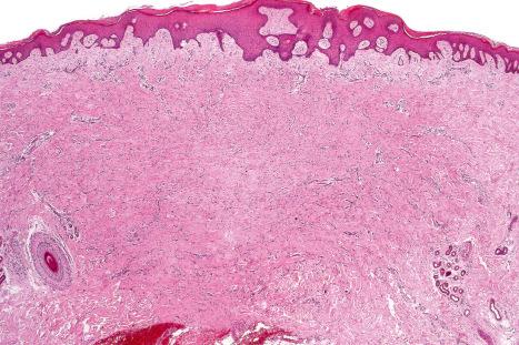 Fig. 35.218, Fibrous histiocytoma (dermatofibroma): the epithelium overlying the tumor is often acanthotic.