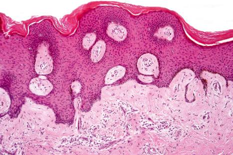 Fig. 35.219, Fibrous histiocytoma (dermatofibroma): the tumor is often separated from the epidermis by a grenz zone.