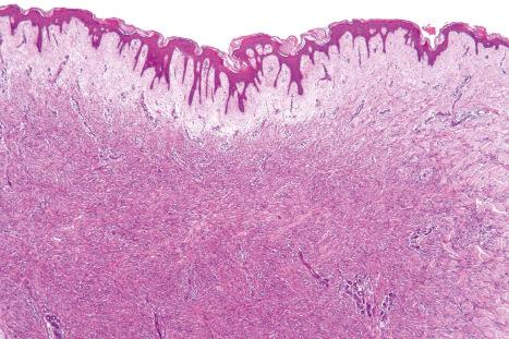 Fig. 35.220, Fibrous histiocytoma (dermatofibroma): in this example, there is an extensive grenz zone.