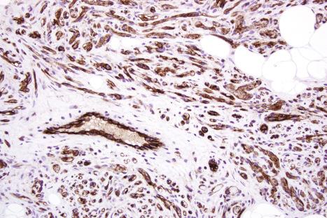 Fig. 35.22, Cellular angiolipoma: the vessels can be outlined with CD31.