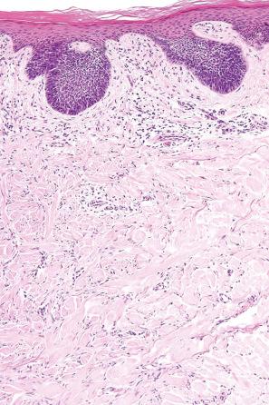 Fig. 35.221, Fibrous histiocytoma (dermatofibroma): proliferation of basaloid cells reminiscent of trichoblastoma.