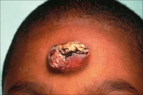 Fig. 35.224, Cellular fibrous histiocytoma: children may rarely be affected. Ulceration is sometimes a feature.