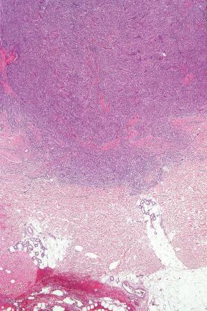 Fig. 35.226, Cellular fibrous histiocytoma: scanning view showing extension into the deep reticular dermis.