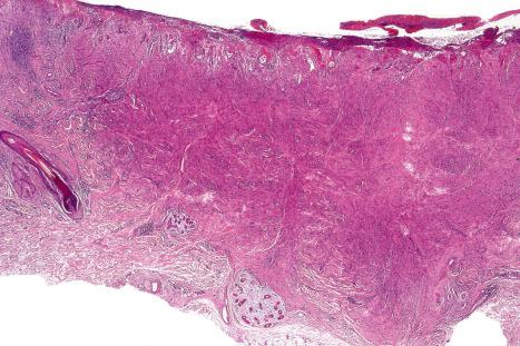 Fig. 35.227, Cellular fibrous histiocytoma: this example shows striking cellularity.