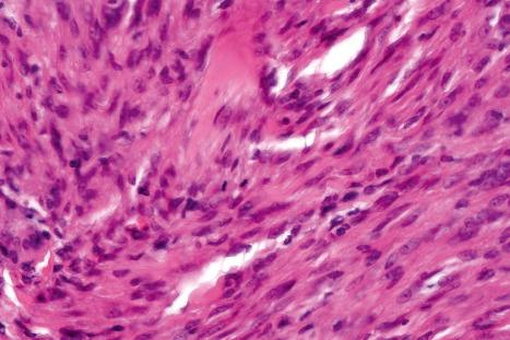 Fig. 35.229, Cellular fibrous histiocytoma: note the mitotic activity.