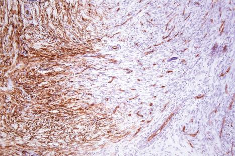 Fig. 35.230, Cellular fibrous histiocytoma: the tumor cells at the edge of the lesion often express CD34.