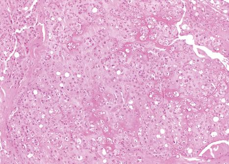 Fig. 35.23, Chondroid lipoma: myxoid and hyalinised stroma associated with variably vacuolated cells.