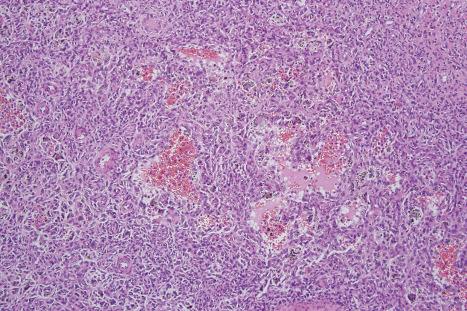 Fig. 35.232, Aneurysmal fibrous histiocytoma: a densely cellular infiltrate is present in the deeper dermis. Blood-filled cystic spaces are evident.