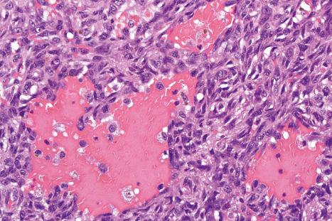 Fig. 35.233, Aneurysmal fibrous histiocytoma: the hemorrhagic spaces are devoid of an endothelial lining.