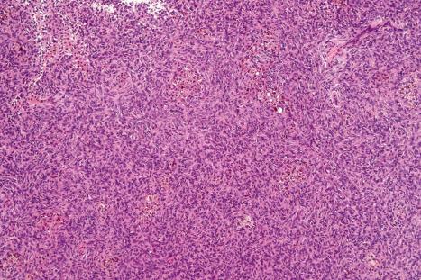 Fig. 35.234, Hemosiderotic fibrous histiocytoma: the marked vascularity and heavy hemosiderin content sometimes seen in this lesion gives a dark bluish-brown coloration, which clinically may cause confusion with melanoma.