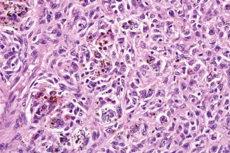 Fig. 35.235, Hemosiderotic fibrous histiocytoma: this variant is also sometimes known as sclerosing hemangioma.