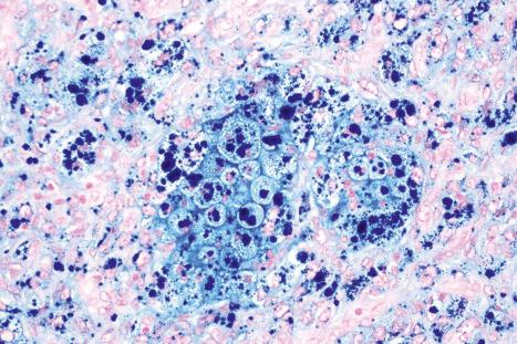 Fig. 35.236, Hemosiderotic fibrous histiocytoma: a Perl stain highlights the hemosiderin.