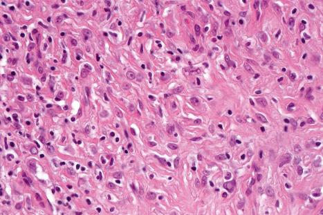 Fig. 35.240, Epithelioid benign fibrous histiocytoma: high-power view.