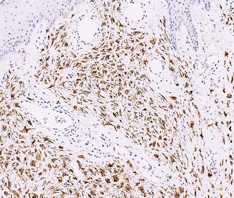 Fig. 35.242, Epithelioid benign fibrous histiocytoma: the tumor cells are often positive for ALK1.