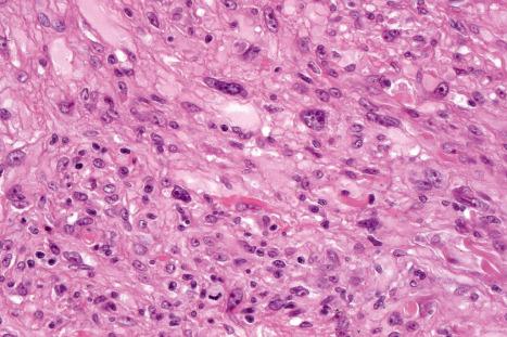 Fig. 35.244, Atypical benign fibrous histiocytoma: there is striking nuclear pleomorphism. Note the mitotic figure.