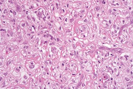 Fig. 35.246, Lipidized (‘ankle-type’) fibrous histiocytoma: high-power view of foamy histiocytes.