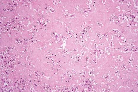 Fig. 35.247, Lipidized (‘ankle-type’) fibrous histiocytoma: this field shows densely hyalinized collagen reminiscent of amyloid.