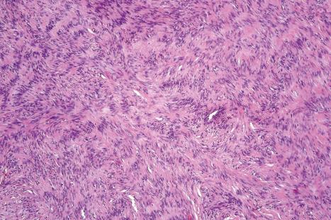 Fig. 35.248, Palisading fibrous histiocytoma: occasionally, palisading mimicking Verocay bodies may be a feature.