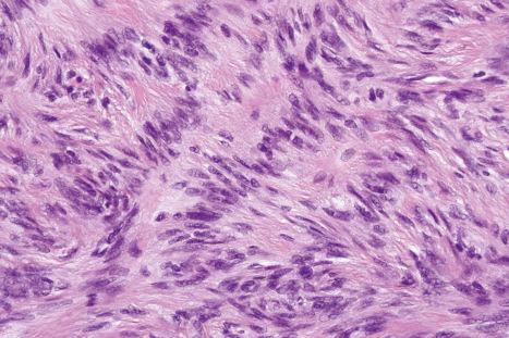 Fig. 35.249, Palisading fibrous histiocytoma: high-power view.