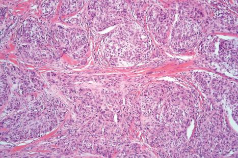 Fig. 35.252, Cellular neurothekeoma: the tumor consists of nests and fascicles of eosinophilic cells.