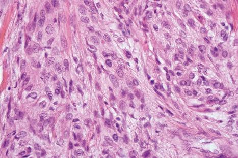 Fig. 35.253, Cellular neurothekeoma: the cells have abundant cytoplasm and vesicular nuclei.