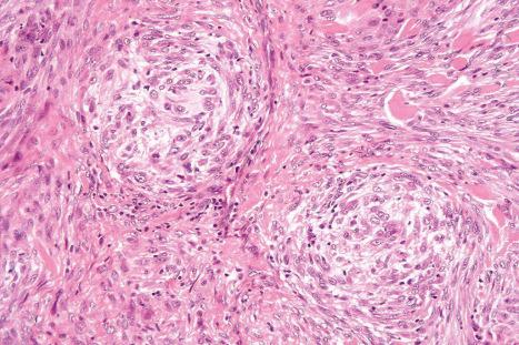 Fig. 35.255, Atypical cellular neurothekeoma: tumor cells show variation in size and there is cytologic atypia.